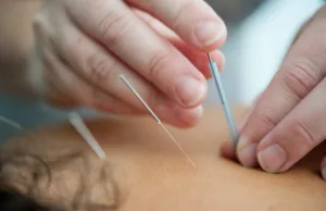 Closeup of clinician applying acupuncture needles to patient's back